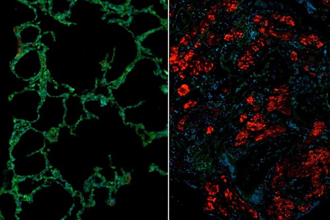 microscopic images in green and red show scleroderma of the lung caption: Immunofluorescence images showing healthy (left) and scleroderma (right) lung. The scleroderma lung shows reduced levels of cathepsin L (green) and increases levels of fibroblast activation marker (red).