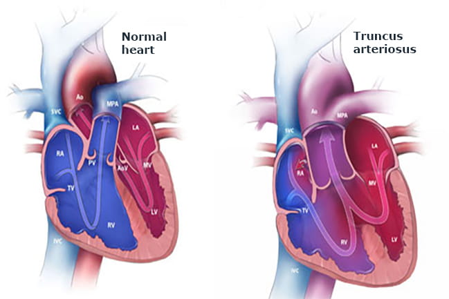 Illustrated normal heart and truncus arteriosus heart