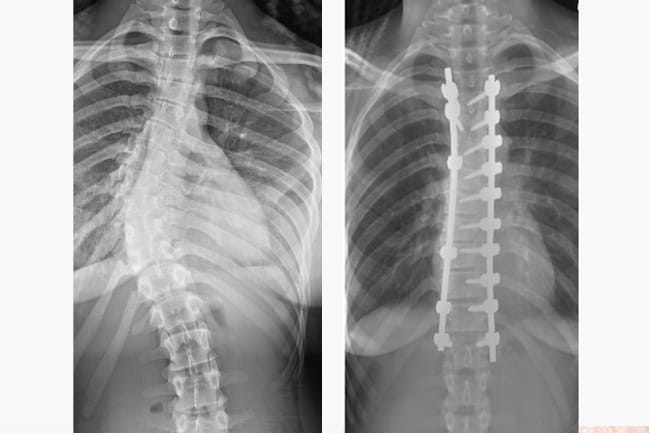 X-ray images showing curved spine and straightened spine with screws