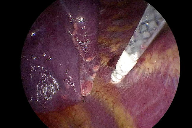 Microscopic view of cryoprobe inserted into chest tissue