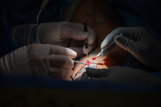 surgeons perform supermicrosurgery on patients with lymphedema 