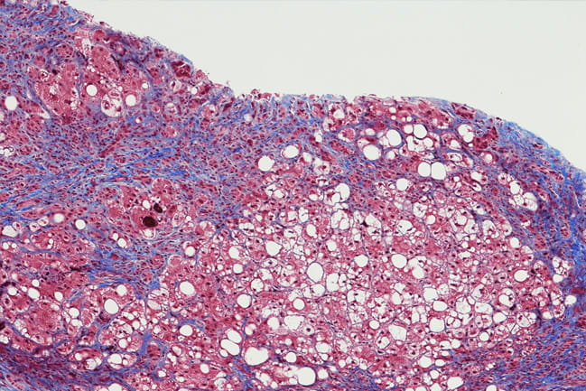microscopic image of liver cells with fibrosis