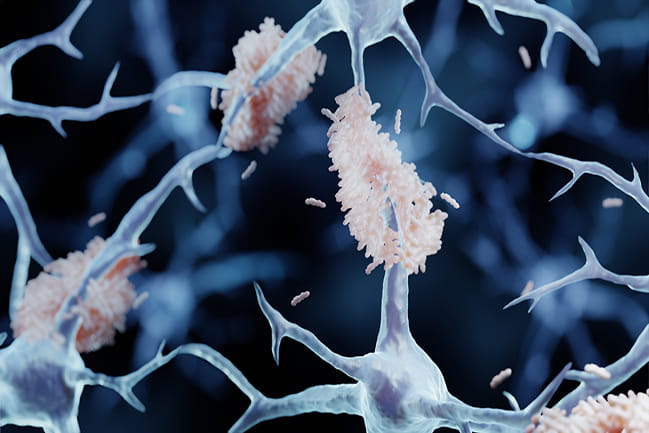 Illustration of neurons with amyloid plaques in Alzheimer's disease
