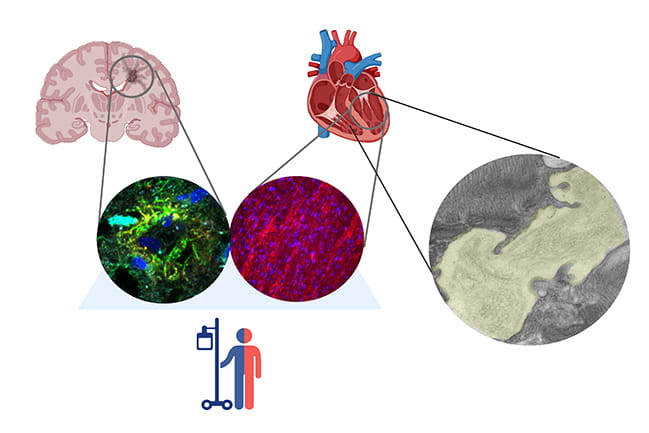 Diagram of brain and heart with inset microscopic images