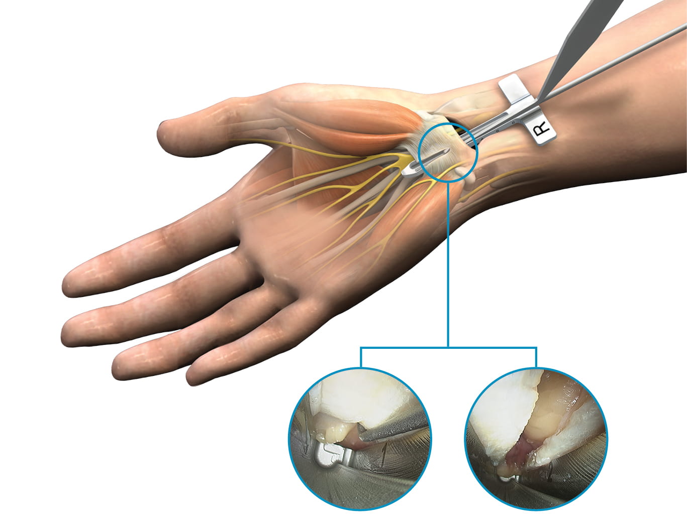 Illustration of carpal tunnel release with endoscopic kit