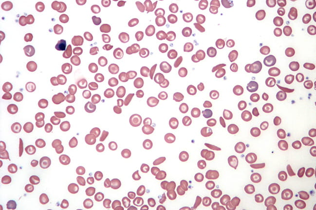blood smear of sickle cell disease under a microscope