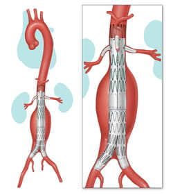 Diagram of fenestrated repair.
