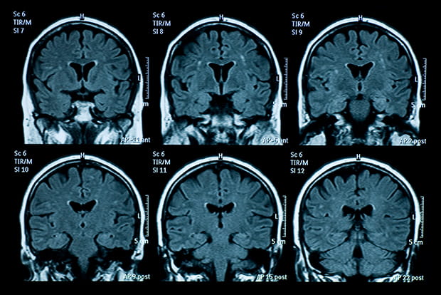 Composite of brain MRI scans