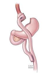Gastric Bypass ASMBS