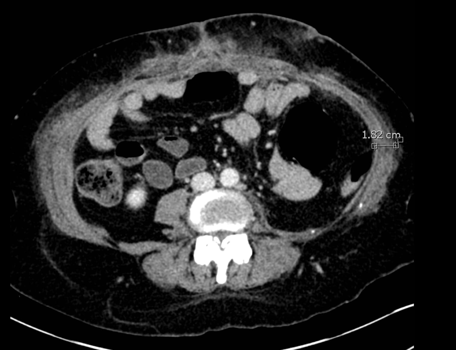 black and white scanned image of a cross-section of the abdomen