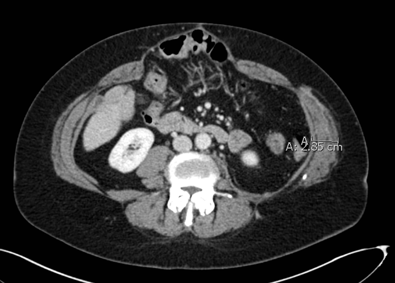 black and white CT scan of abdomen