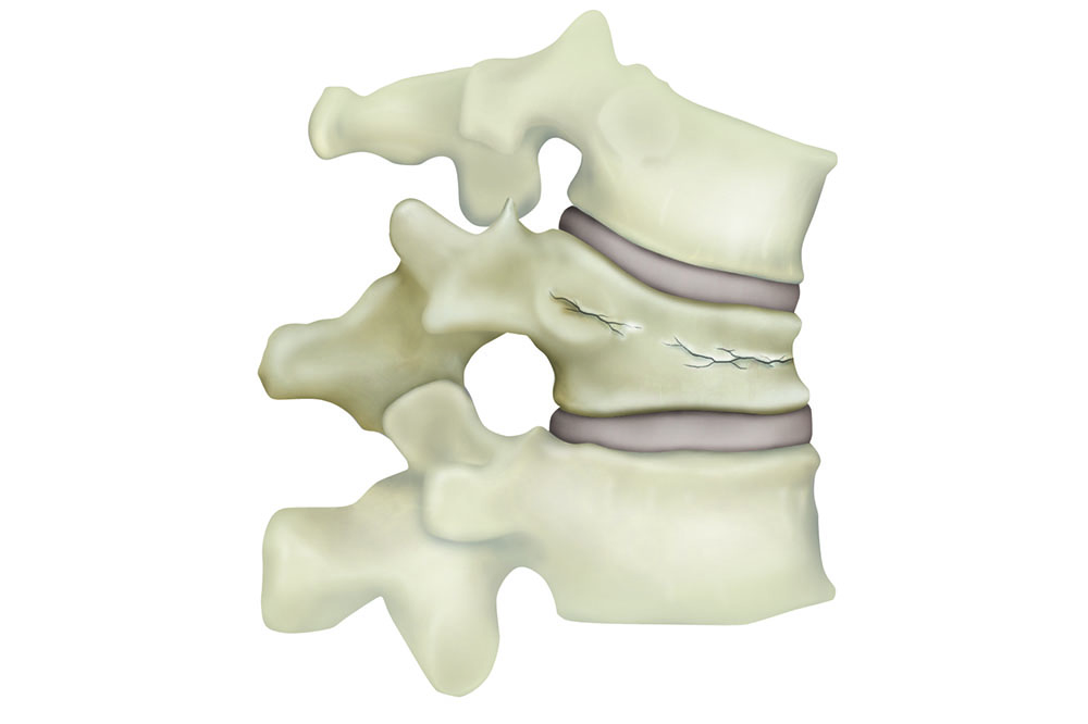 illustration of fractured vertebra