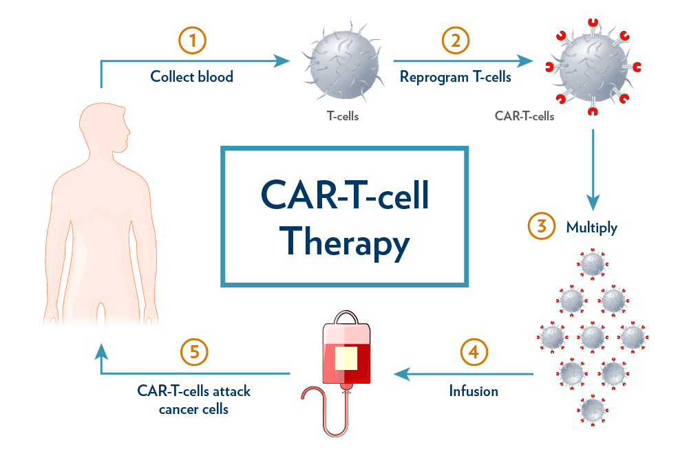 diagram showing the five steps of the CAR-T-cell therapy process: collect blood, reprogram T-cells, multiply, infusion, CAR-T-cells attack cancer cells