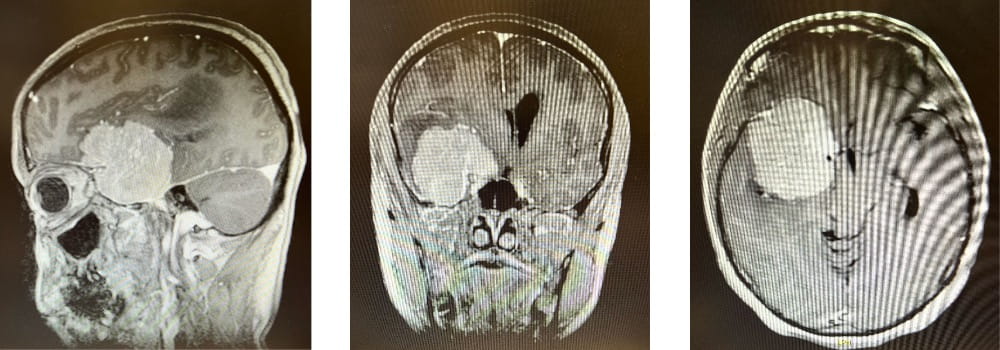 A series of three CT images of Tamara Palmer's head, each showing an orange-sized tumor in her brain