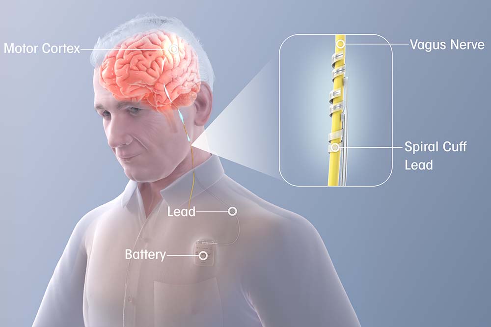 Illustration of a man. It highlights his brain. The words motor cortex are beside his head. A closeup on the right side shows the vagus nerve and the spiral cuff lead. Illustration also shows the lead and a battery operated device in his chest.