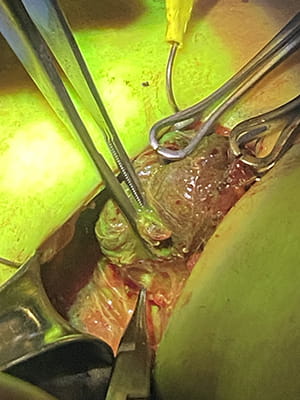 a nerve is illuminated green in a thyroid
