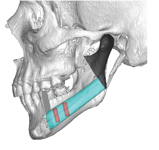 a computer image of a skull with a colored section on the jawbone