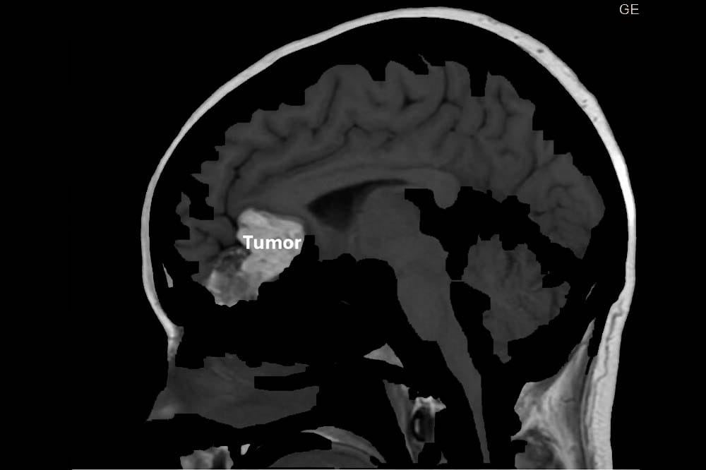 Dark scan of a human head where you can see the brain from the side. A small area toward the front of the head is highlighted in grey.